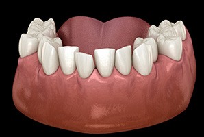 a digital design of a model of a mouth showing crowded teeth