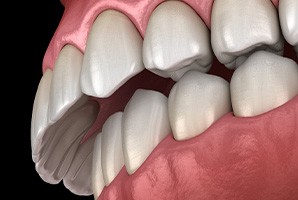 a digital design of a model of a mouth showing an overbite