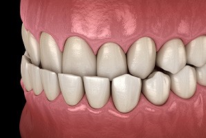 a digital design of a model of a mouth showing an underbite