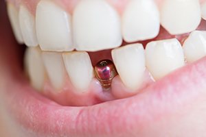 Close-up of a single dental implant in Dallas, TX with healing cap