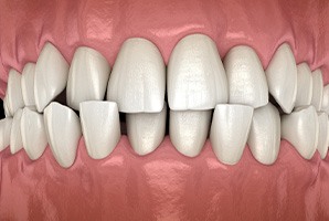 a digital design of a model of a mouth showing a crossbite