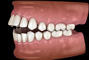 a digital design of a model of a mouth showing open bite