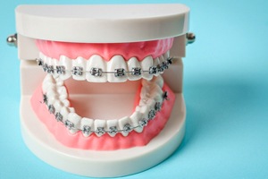 dental model of braces