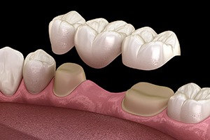 a digital illustration of a traditional dental bridge