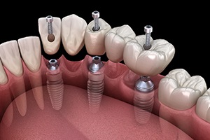 a digital illustration of an implant dental bridge