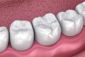 3D image of teeth with dental sealants 