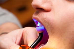 a patient having their teeth bonded