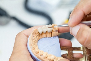 dentist crafting a dental crown on a mold of a mouth