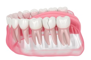 computer illustration of a broken molar