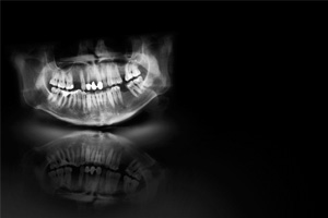 an X-ray showing missing teeth