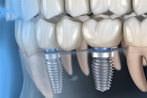 a digital illustration showing how dental implants work
