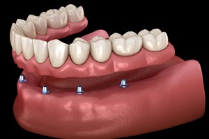 a digital illustration of an implant denture 