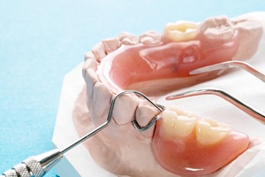 a partial denture placed on a plaster model of a mouth