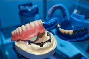 a model of a mouth showing how implant dentures work