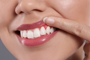 a person raising their lip to reveal inflamed gums