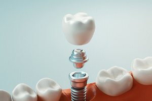 dental implant in Dallas