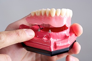 dentist holding a model of an implant denture