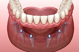 full implant denture supported by six dental implants
Candidate 
