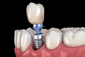 Dental implant in Dallas