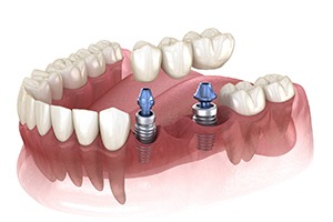 Implant bridge in Dallas