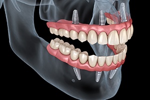 Implant denture in Dallas