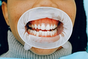 Woman with misaligned teeth