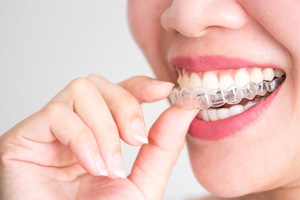 A woman inserting an Invisalign aligner