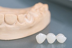 Model smile with dental bridge restoration