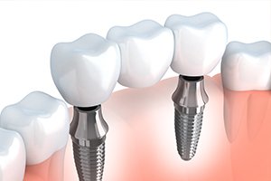 Animation of implant supported fixed bridge