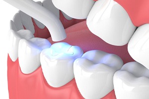 dental filling illustration