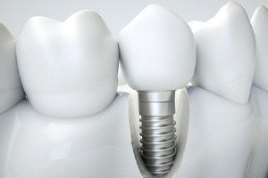 dental implant illustration