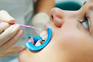 Closeup of patient receiving fluoride treatment