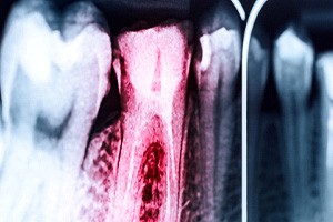 an X-ray with a red tooth to signify it's infected