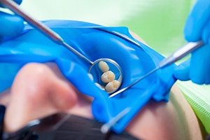 a close-up of a tooth being examined by a dentist