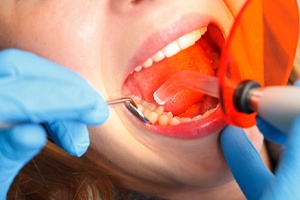 dentist curing a cavity filling