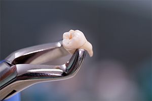 Metal clasp holding extracted tooth