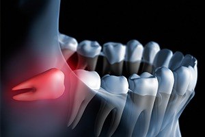 Animation of impacted tooth