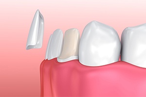 illustration of how a veneer is placed onto a tooth
