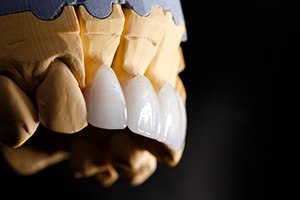 a clay model of a mouth showing porcelain veneers placed over it