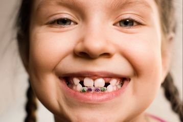 Child with braces only on bottom front teeth