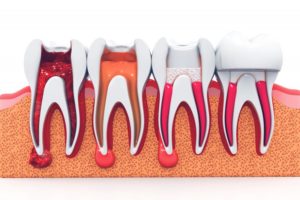 a graphic showing the stages of an infected tooth undergoing root canal therapy