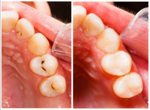before and after photos of a person's teeth that receive a cavity filling