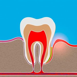 a graphic illustration of a periodontal pocket