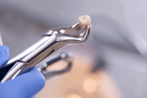 a pair of dental forceps holding an extracted tooth