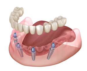 a computer model of all-on-4 implant dentures