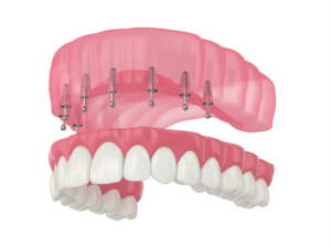 a computer model showing implant dentures